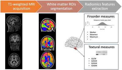 Explainable machine learning radiomics model for Primary Progressive Aphasia classification